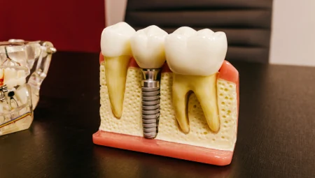 Cấy ghép Implant Nha Khoa Cao Cấp