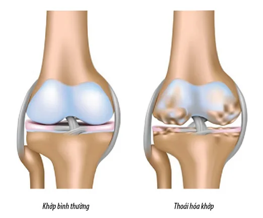 Comprehensive Overview of Knee Osteoarthritis - SANTE Hospital, Binh Thanh, HCMC