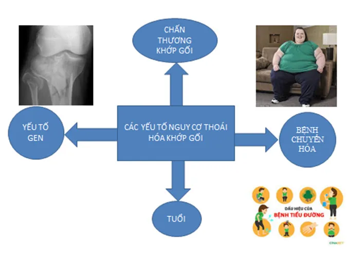 Overview of Knee Osteoarthritis - Image 2 - SANTE Hospital, Binh Thanh, HCMC
