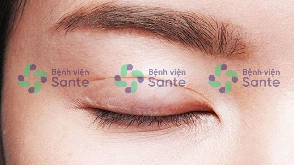 Bệnh viện phẫu thuật chỉnh hình cắt mí mắt tại TPHCM ở đâu tốt nhất