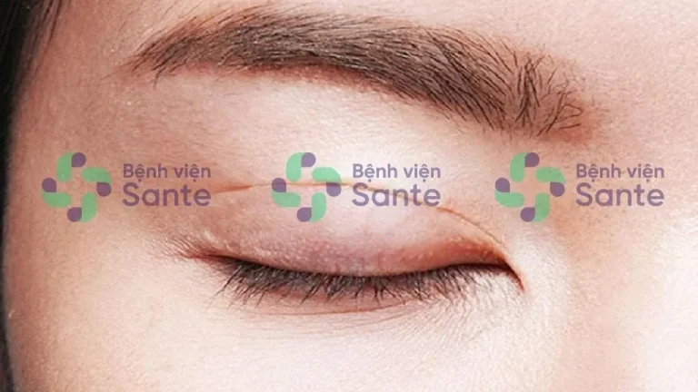 Best Hospital for Blepharoplasty and Eyelid Surgery in Ho Chi Minh City