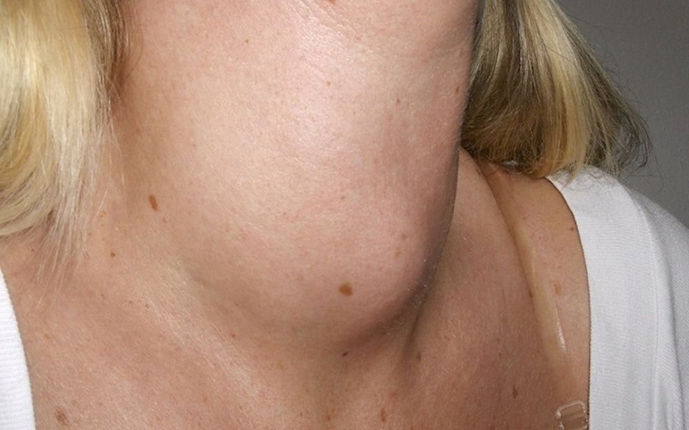 What is a Goiter? Causes and Prevention