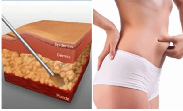 Sante Hospital - Does Abdominal Liposuction Require Downtime?