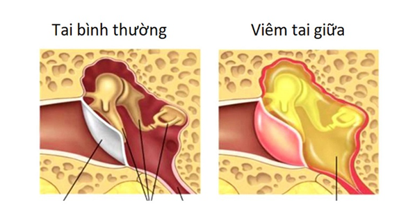 Is ear discharge dangerous and how to manage ear discharge