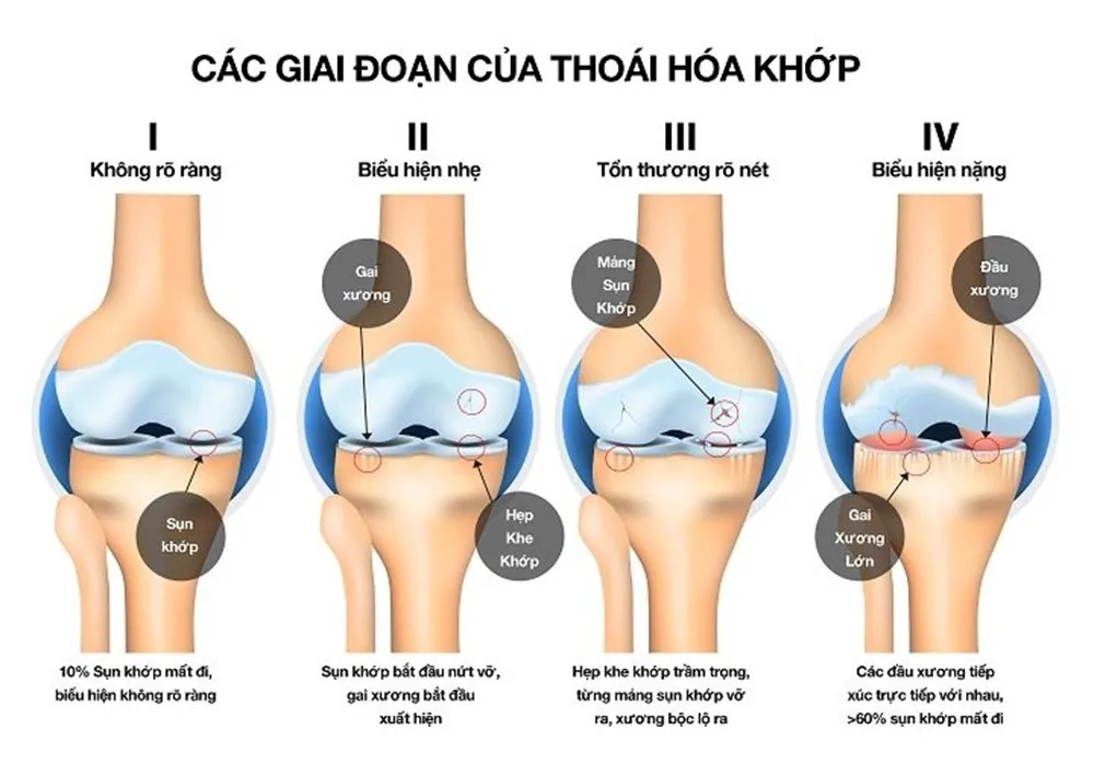 Sante Hospital - Osteoarthritis