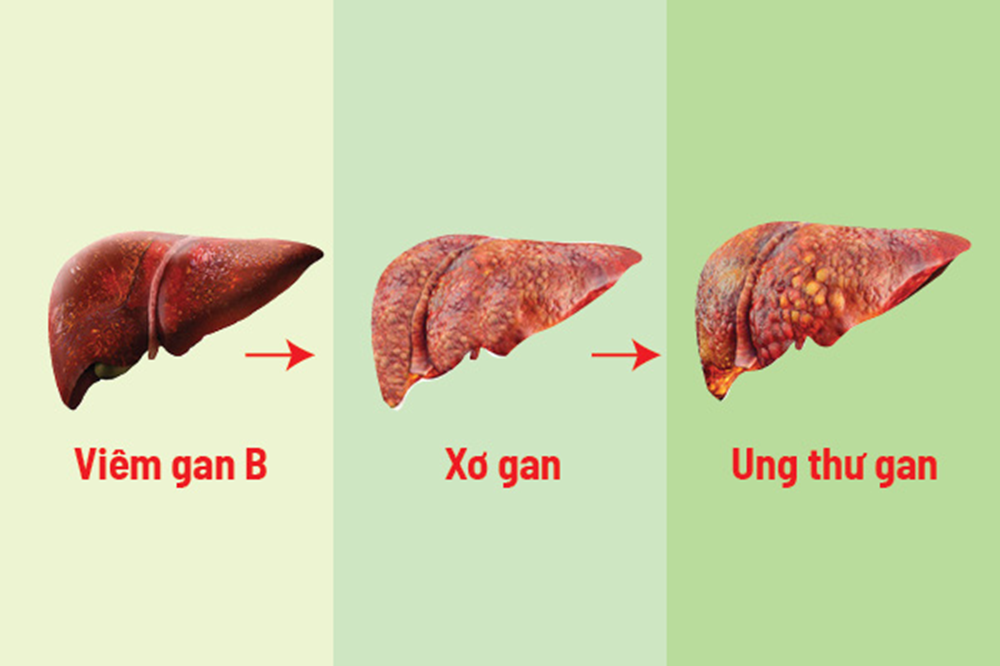 Are Cirrhosis and Liver Cancer the Same? Key Warning Signs
