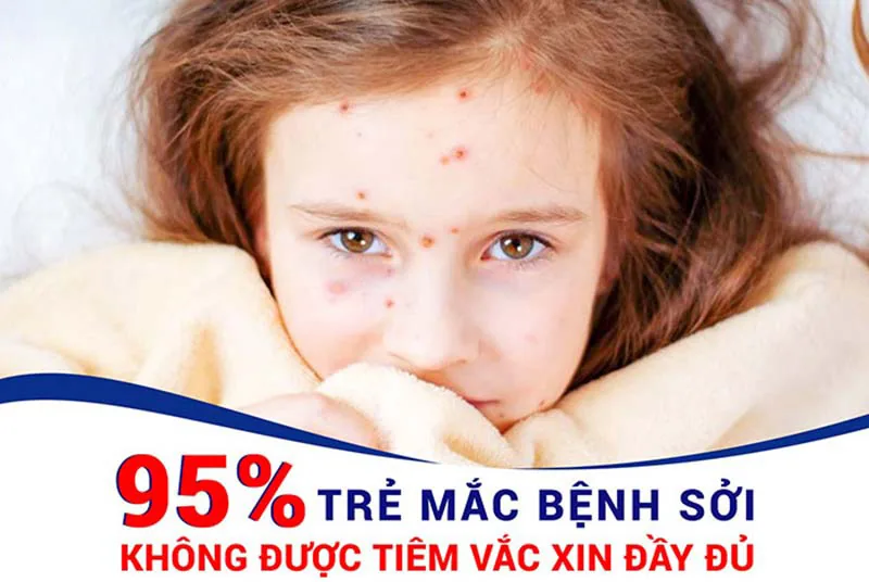 MEASLES: ETIOLOGY, CLINICAL MANIFESTATIONS, AND PREVENTIVE PROTOCOLS - Image 2 - SANTE Hospital Binh Thanh, HCMC