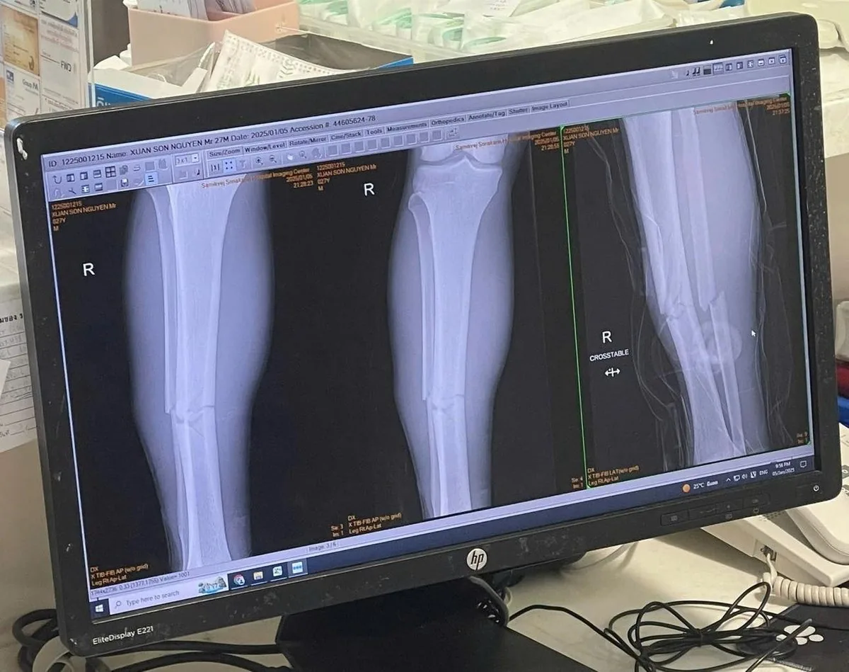 HOW LONG DOES IT TAKE TO RECOVER FROM A LOWER LEG (SHINBONE) FRACTURE? - Image 3 - SANTE Hospital, Binh Thanh, HCMC