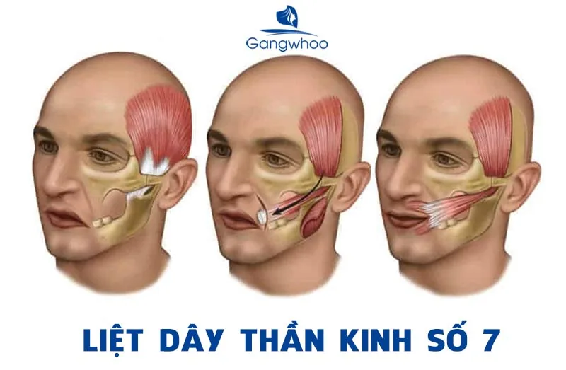 Peripheral facial nerve palsy (Bell's palsy), A CONDITION CAUSING FACIAL ASYMMETRY AND DEFORMITY - Image 2 - SANTE Hospital, Binh Thanh, HCMC