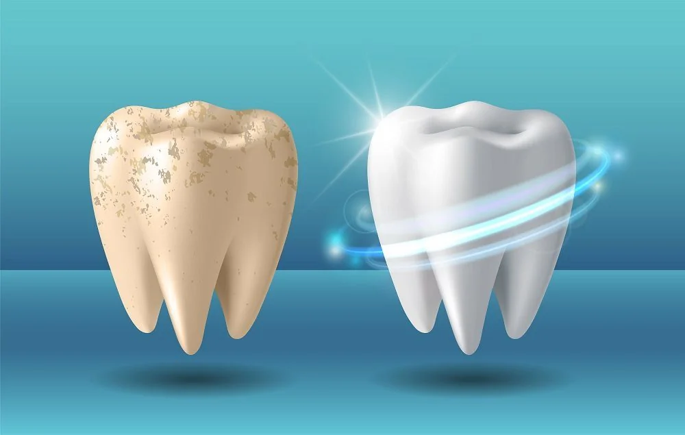 Sante Hospital - Teeth Whitening (Image 2)