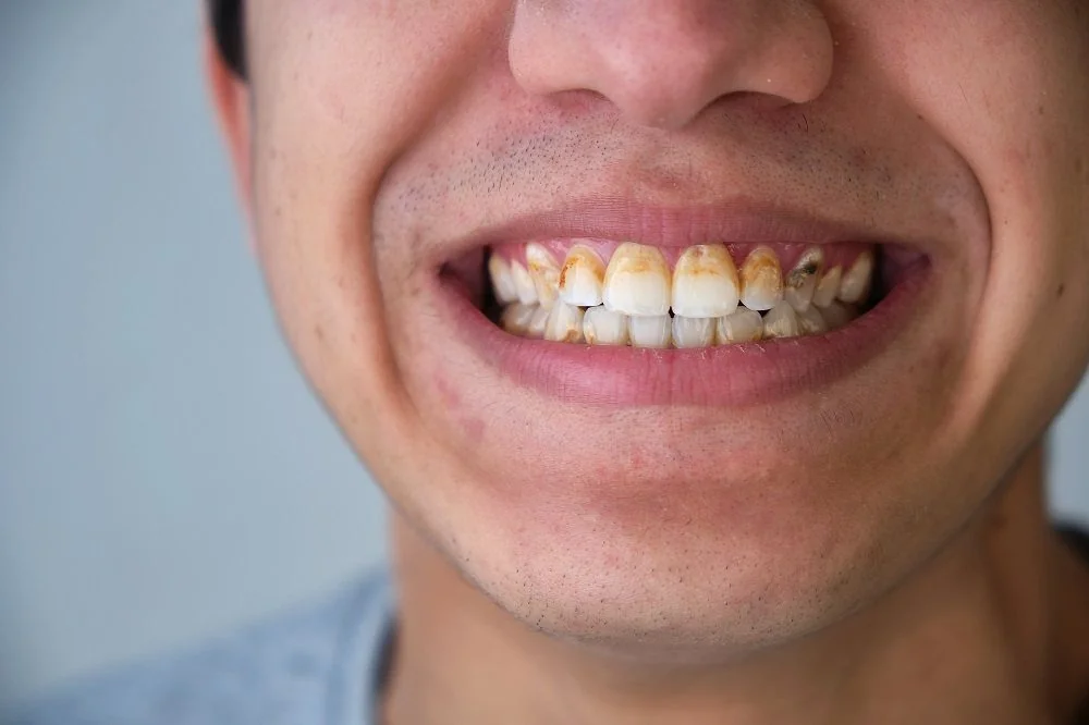 Sante Hospital - Porcelain Veneers (Dental Veneers) (Image 4)