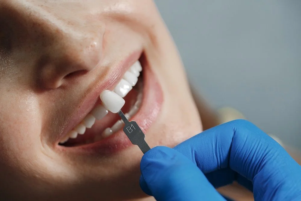 SANTE Hospital - Porcelain Veneers