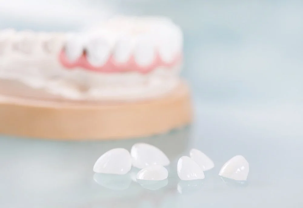 Sante Hospital - Porcelain Veneers (Dental Veneers) (Image 2)