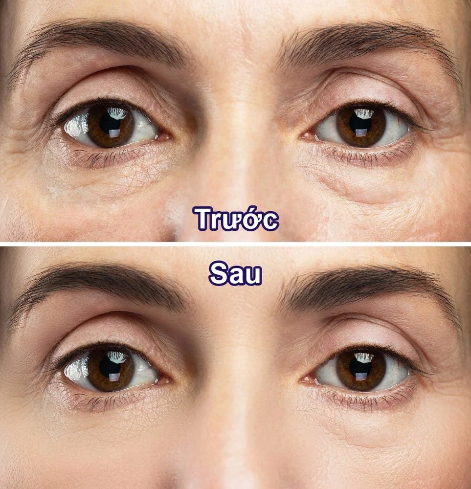 Sante Hospital - Aesthetic Blepharoplasty & Eye Plastic Surgery (Figure 3) Sante Hospital - Aesthetic Blepharoplasty & Eye Plastic Surgery (Figure 3)
