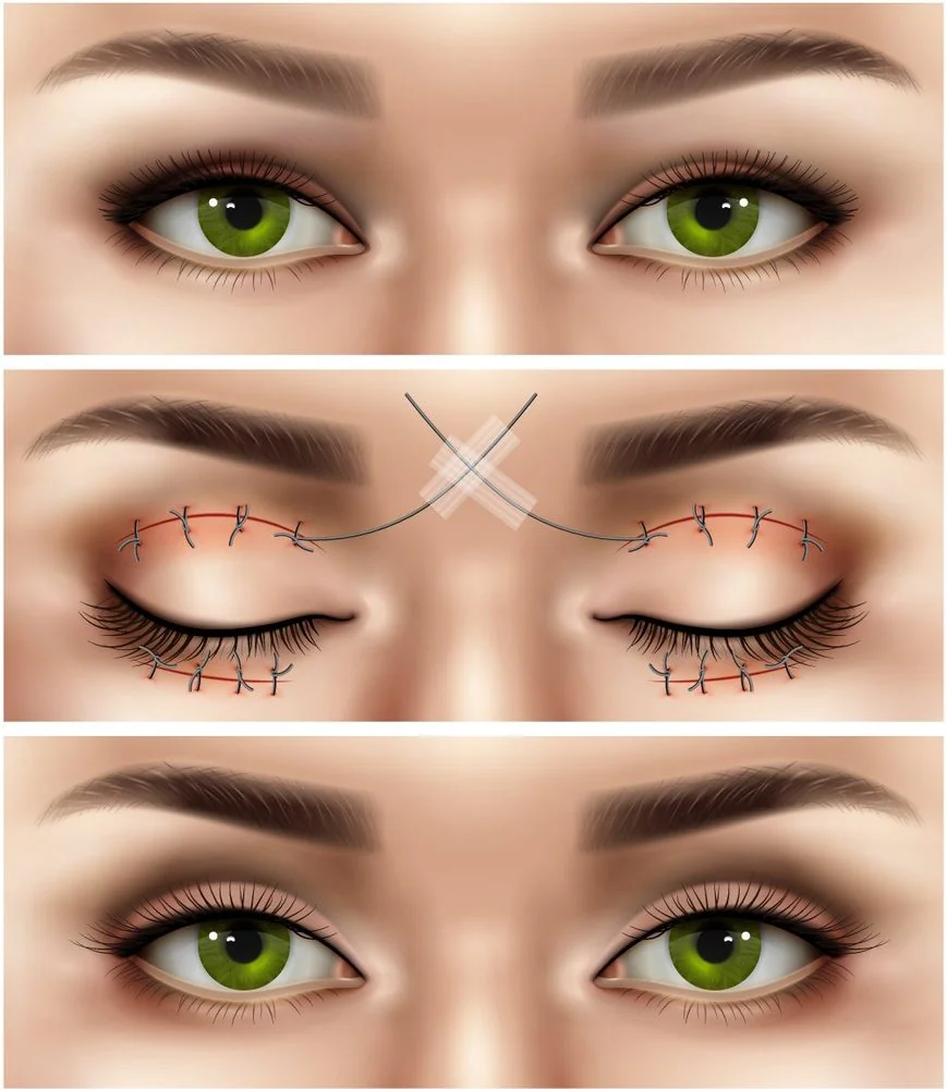Sante Hospital - Aesthetic Blepharoplasty & Eye Plastic Surgery (Figure 2) Sante Hospital - Aesthetic Blepharoplasty & Eye Plastic Surgery (Figure 2)