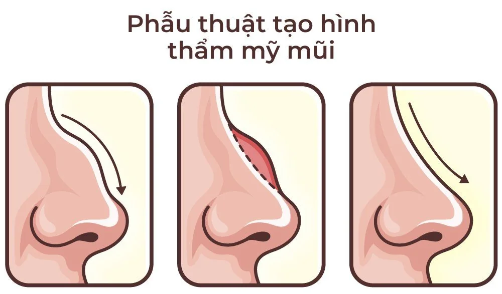 Aesthetic Rhinoplasty Surgery