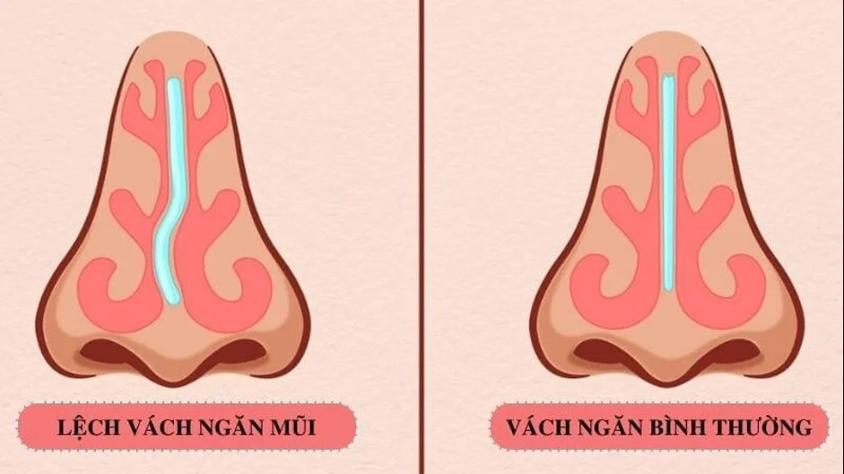 Sante Hospital - DEVIATED NASAL SEPTUM: WHEN IS SURGERY REQUIRED ? (Figure 2) Sante Hospital - DEVIATED NASAL SEPTUM: WHEN IS SURGERY REQUIRED ? (Figure 2)