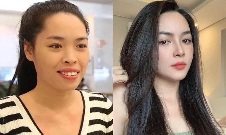 Sante Hospital - Plastic surgery completely transforms facial appearance (Figure 4) Sante Hospital - Plastic surgery completely transforms facial appearance (Figure 4)