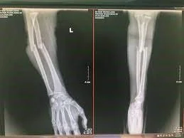 Hình ảnh XQ gãy xương cẳng tay - Bệnh viện SANTE Bình Thạnh, TP.HCM