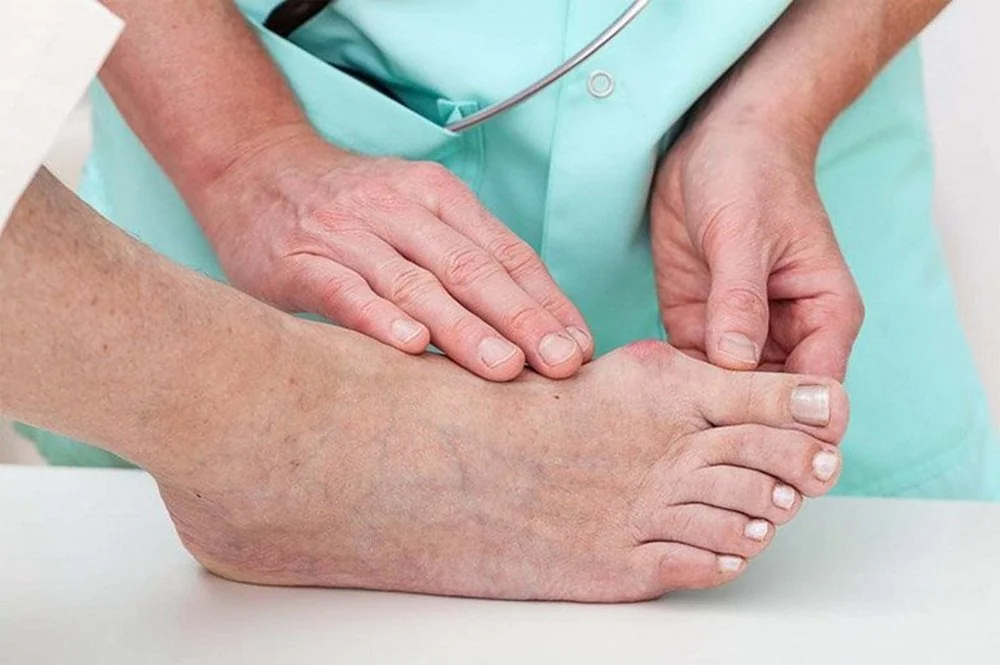 Sante Hospital - Gout - No Longer a Disease of the Affluent
