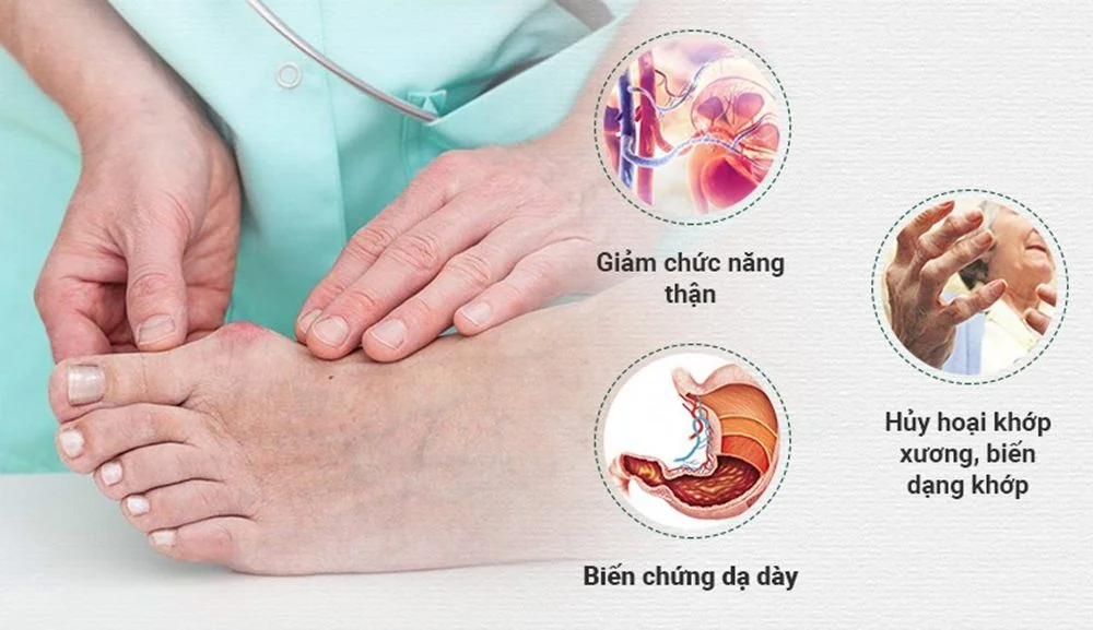 Sante Hospital - Gout - No Longer a Disease of the Affluent (Figure 3)