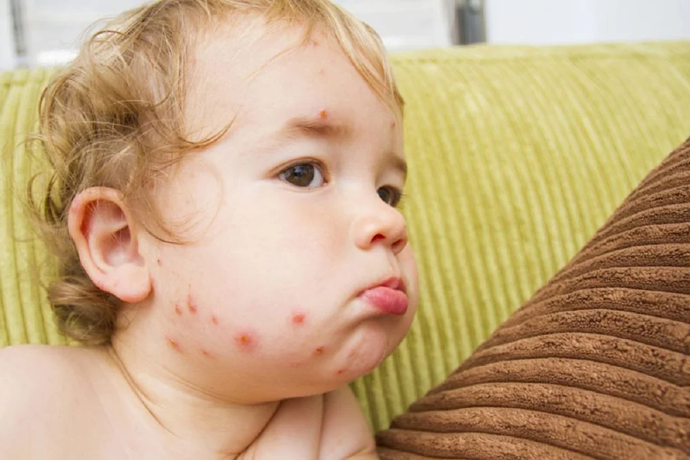 Sante Hospital - Chickenpox in Children: Symptoms and Safe Care Every Mother Should Know (Figure 2)
