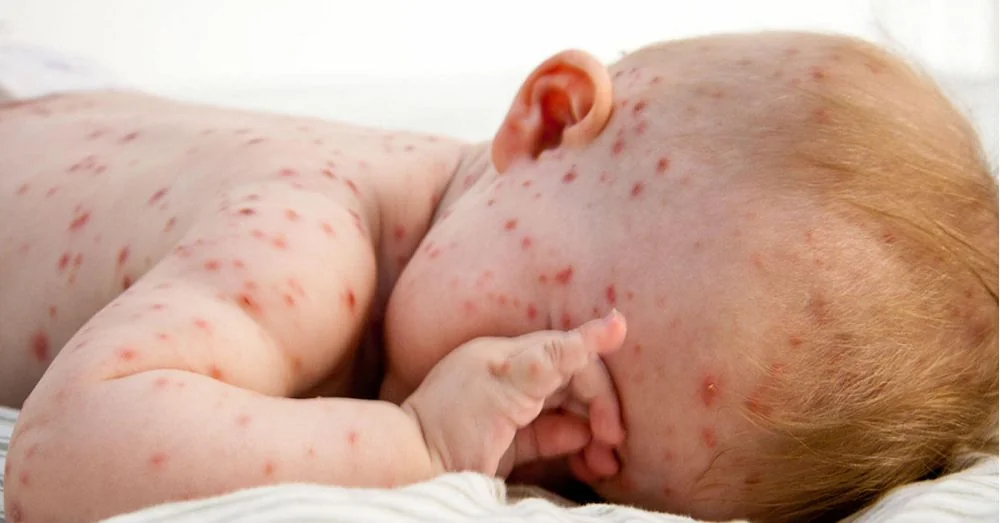 Sante Hospital - Chickenpox in Children: Symptoms and Safe Care Every Mother Should Know (Figure 3)