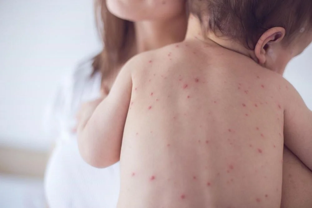 Sante Hospital - Chickenpox in Children: Symptoms and Safe Care Every Mother Should Know (Figure 4)