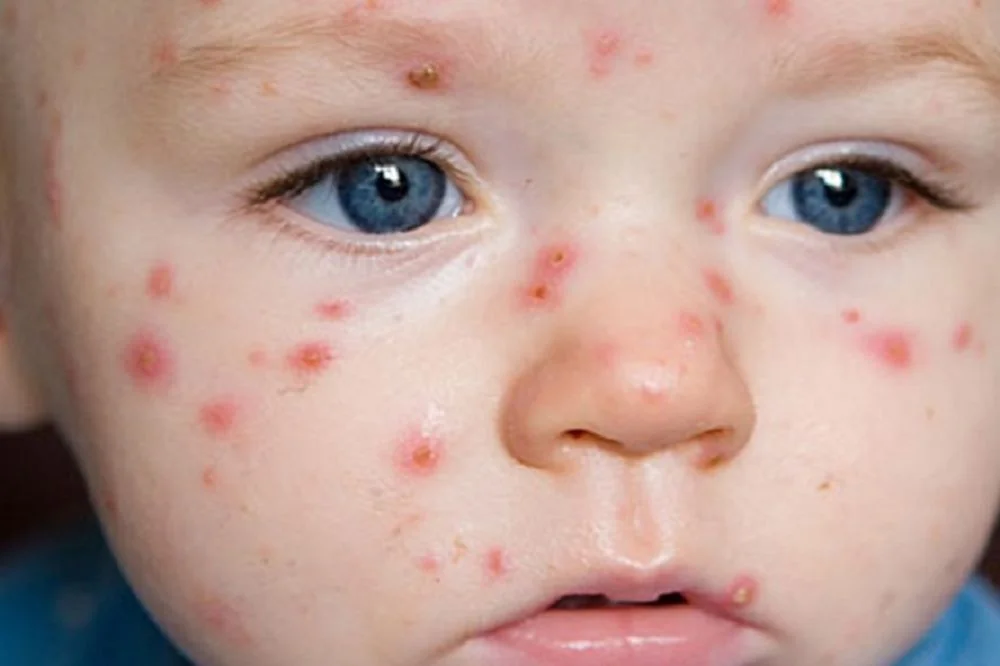 Sante Hospital - Chickenpox in Children: Symptoms and Safe Care Every Mother Should Know