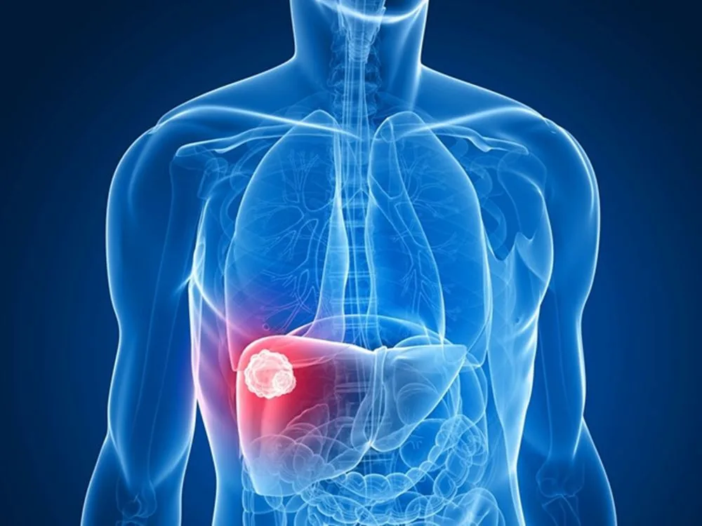 Sante Hospital - Liver Cancer Screening: Early Cancer Detection for Easier Treatment