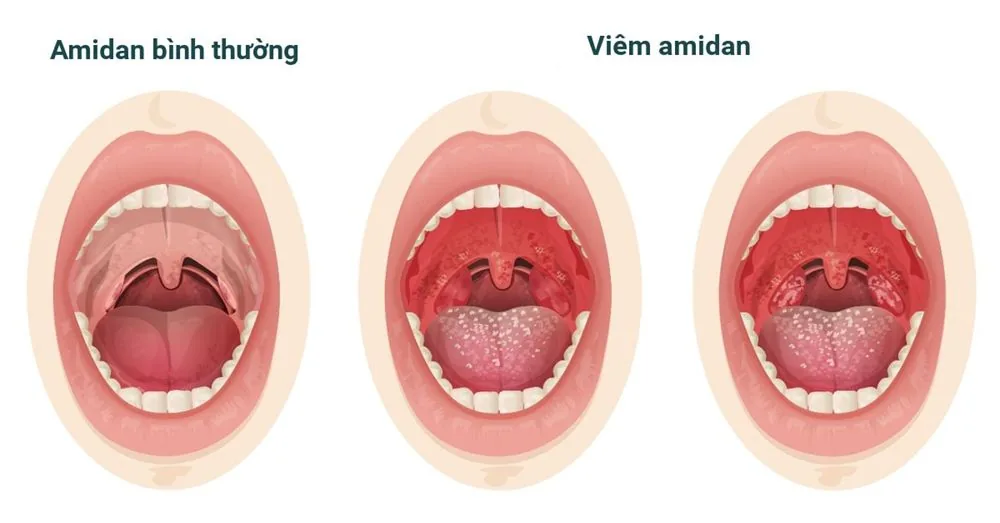 Sante Hospital - What Causes a Sore Throat? Symptoms_ Treatment (Image 4)