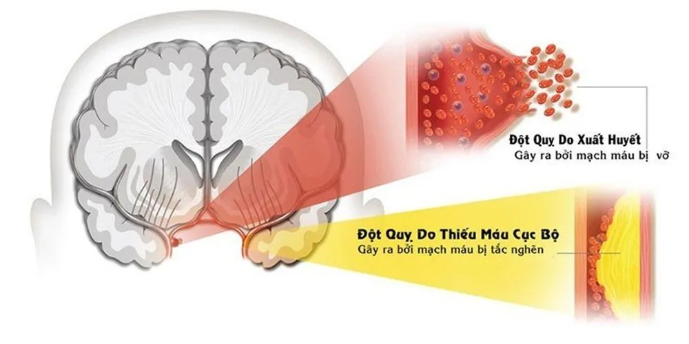 Stroke and Stress: Frequently Asked Questions - Image 3 - SANTE Hospital Binh Thanh, HCMC