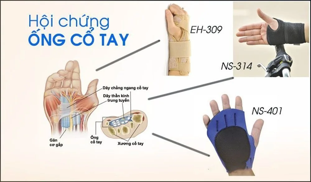 Sante Hospital - Carpal tunnel syndrome (Figure 3)