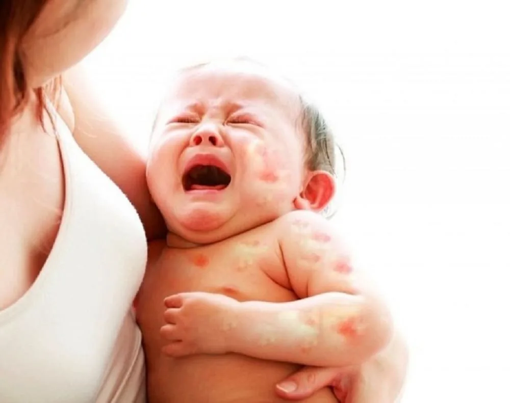 Sante Hospital - Atopic Dermatitis in Children: Causes, Symptoms, and Treatment (Image 2)