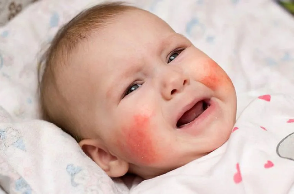 Sante Hospital - Atopic Dermatitis in Children: Causes, Symptoms, and Treatment (Image 4)