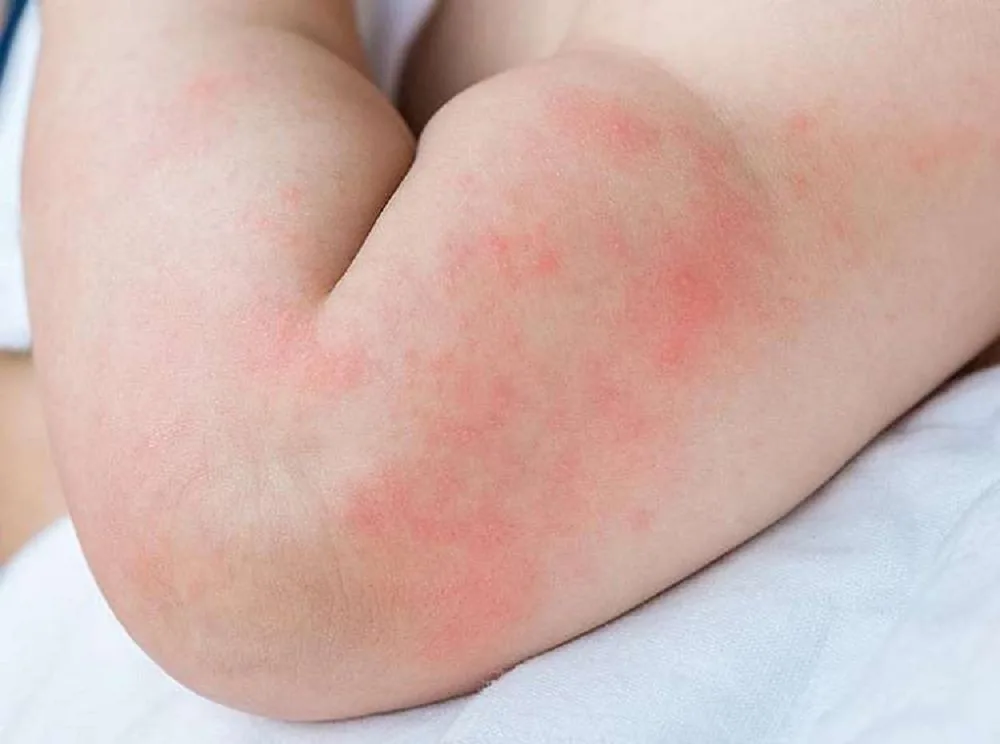Sante Hospital - Proper Care for Pediatric Urticaria (Hives): Essential Guide for Mothers (Image 2)