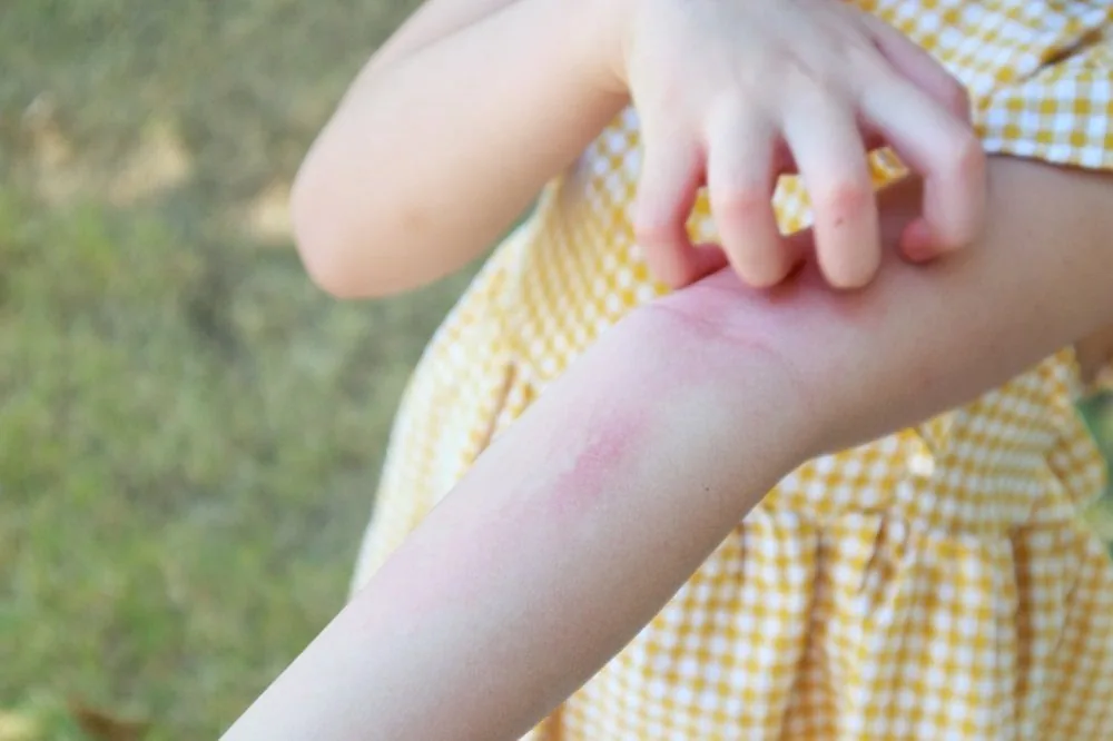 Sante Hospital - Proper Care for Pediatric Urticaria (Hives): Essential Guide for Mothers (Image 4)