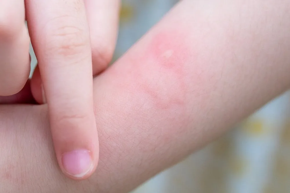 Sante Hospital - Proper Care for Pediatric Urticaria (Hives): Essential Guide for Mothers (Image 3)