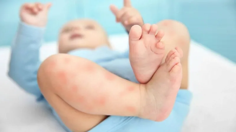 Sante Hospital - Proper Care for Pediatric Urticaria (Hives): Essential Guide for Mothers