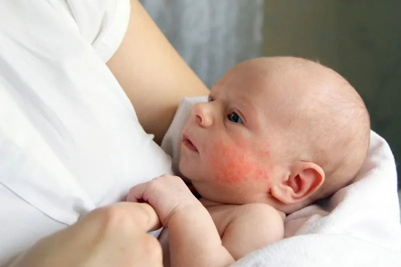 Sante Hospital - Atopic Dermatitis in Children: Causes, Symptoms, and Treatment