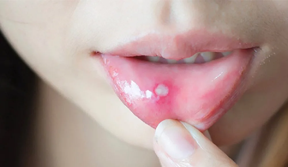 Sante Hospital - Are canker sores dangerous? (Figure 2)