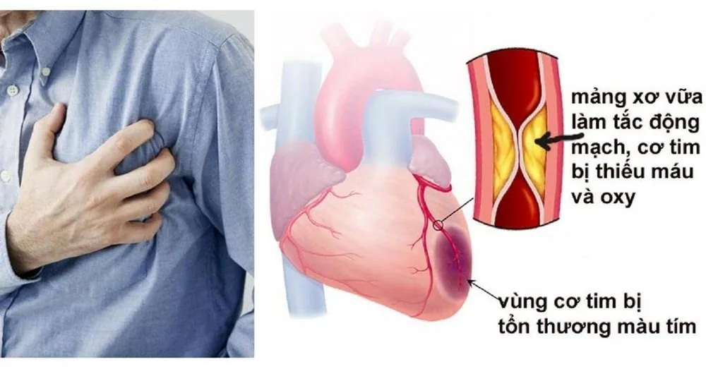 Sante Hospital - Myocardial Infarction - Home First Aid Guide (Figure 2) Sante Hospital - Myocardial Infarction - Home First Aid Guide (Figure 2)