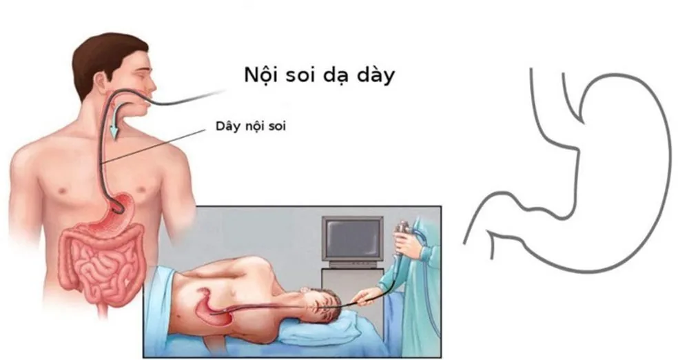 Sante Hospital - Essential Facts About Peptic Ulcers (Image 3)