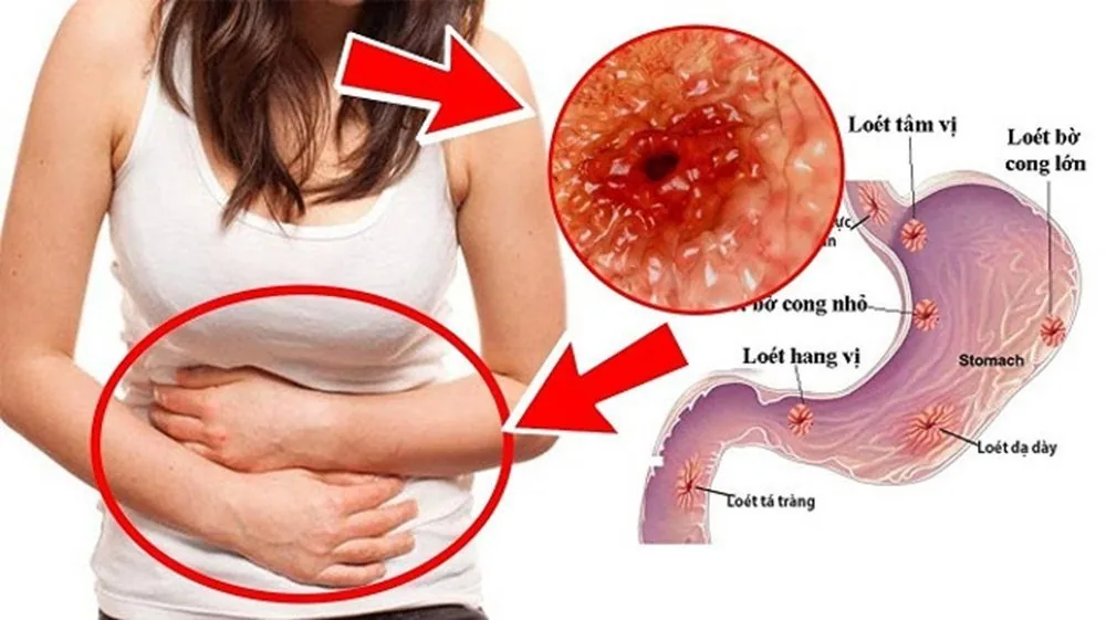 Sante Hospital - Essential Facts About Peptic Ulcers (Image 2)