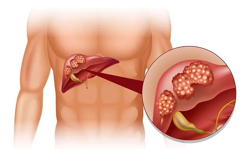 Sante Hospital - Symptoms of Liver Cancer_ Causes_ High-Risk Groups