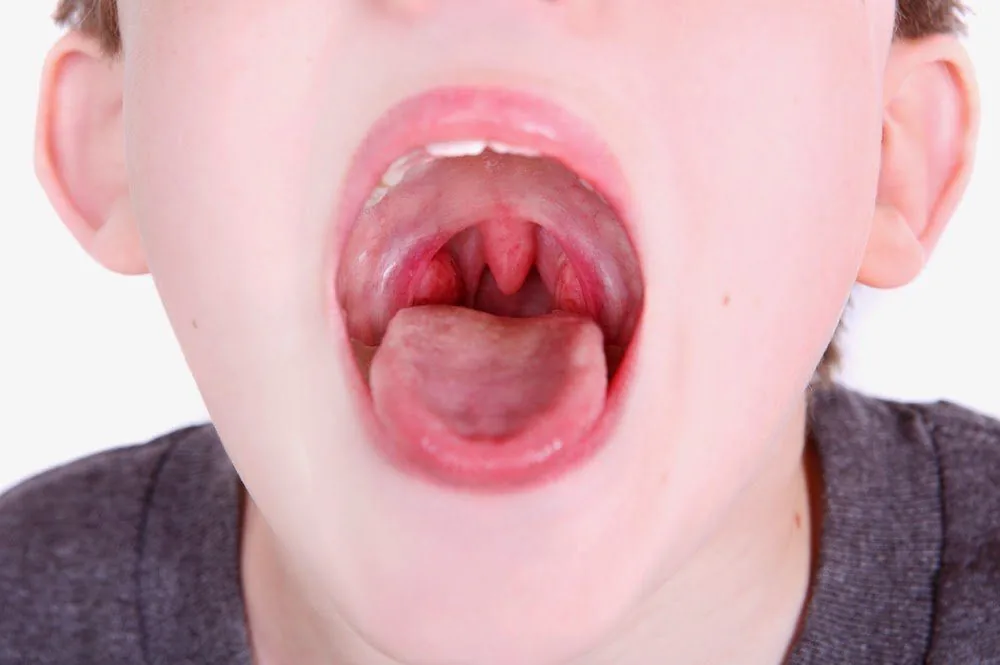 Sante Hospital - What is tonsillitis? Causes_ symptoms and treatment (Figure 2)