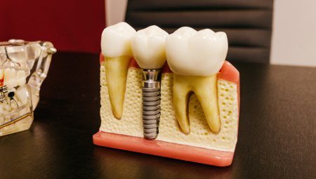 Premium Dental Implant Prosthetics