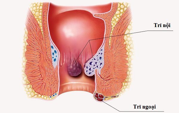 Understanding Hemorrhoids: Causes, Symptoms, and Treatment Options