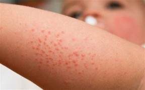 Common dermatological diseases in young children, symptoms, and treatment methods.