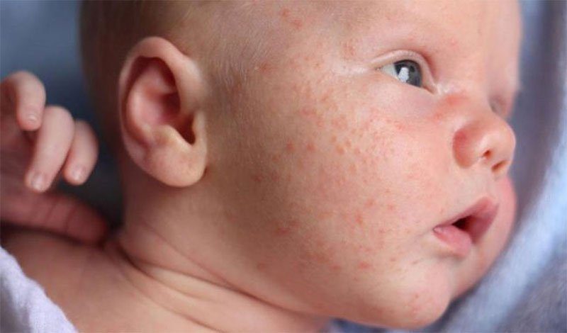 Heat rash in children: Causes, treatment methods, and prevention.